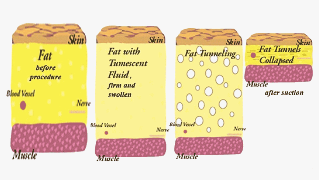 tumescent fluid swelling fat