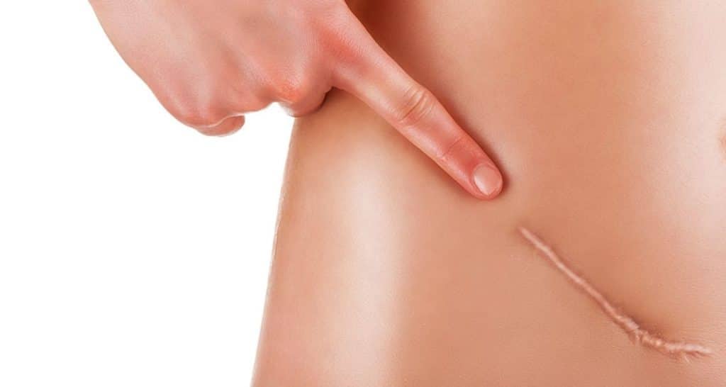 Navigating Laser Scar Removal: Expectations, Process, and Risks 1 scar removal Pandit clinic