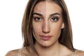 Chemical Peels: What They Are, Conditions Treated, and Candidate Considerations 1 images 18