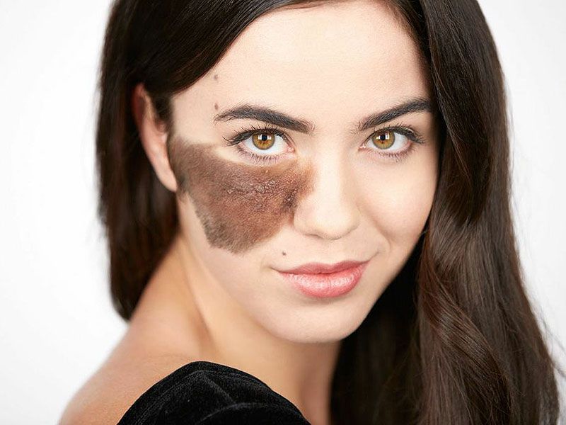 Birth Mark Removal: Types & Effective Methods Explained 1 cassandra naud 800 2426a3dacc4740a48ca66a9058a181dd