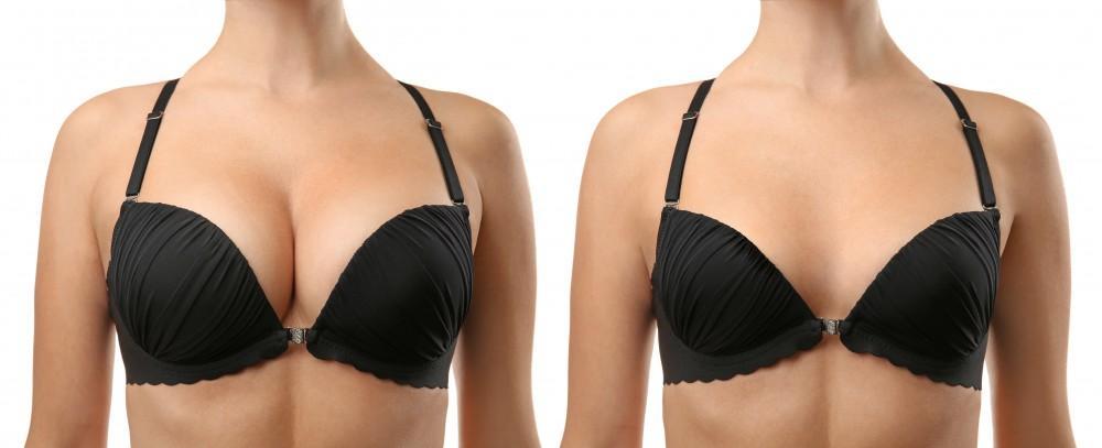Laser Bra Lift Surgery - What Is It? Benefits? Recovery? Cost? 1 2655275