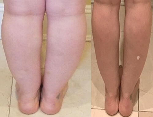 Liposuction for Ankle Fat: Your Guide to Slimmer Ankles 1 CALFANKLE