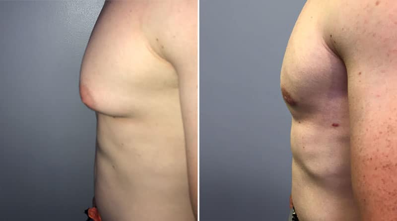 Gynecomastia