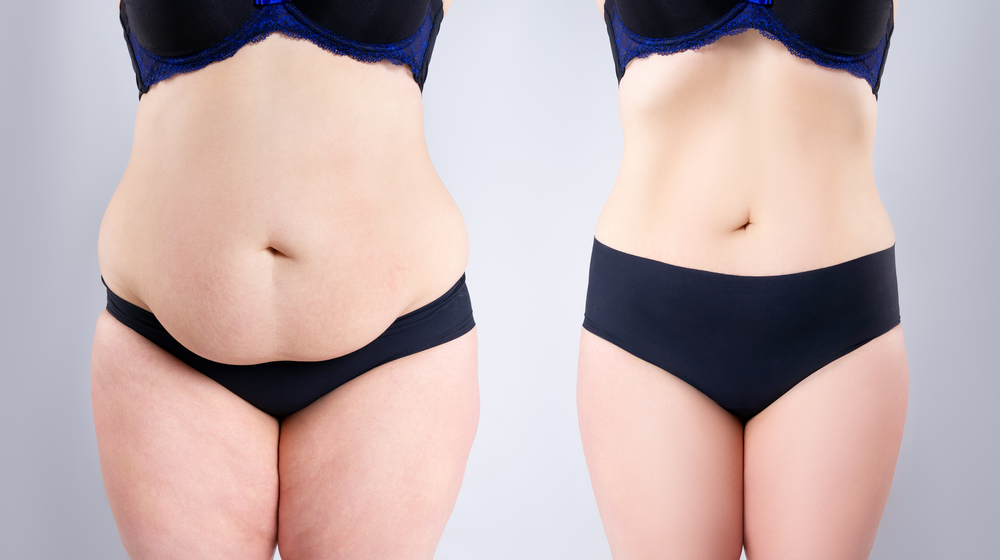Tummy Tuck Benefits and Risks: Key Insights for Recovery 1 Tummy Tuck Surgery