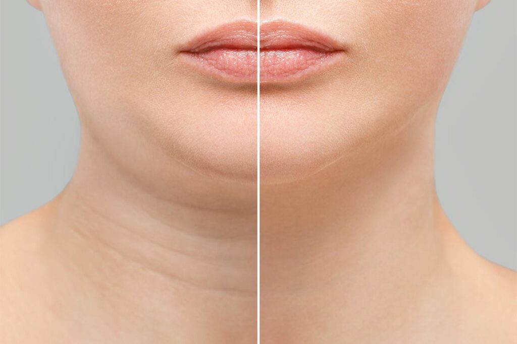 How Painful is a Neck Lift? Surgery & Recovery Insights 1 neck liposuction risk dr lozada philadelphia 1024x683 1