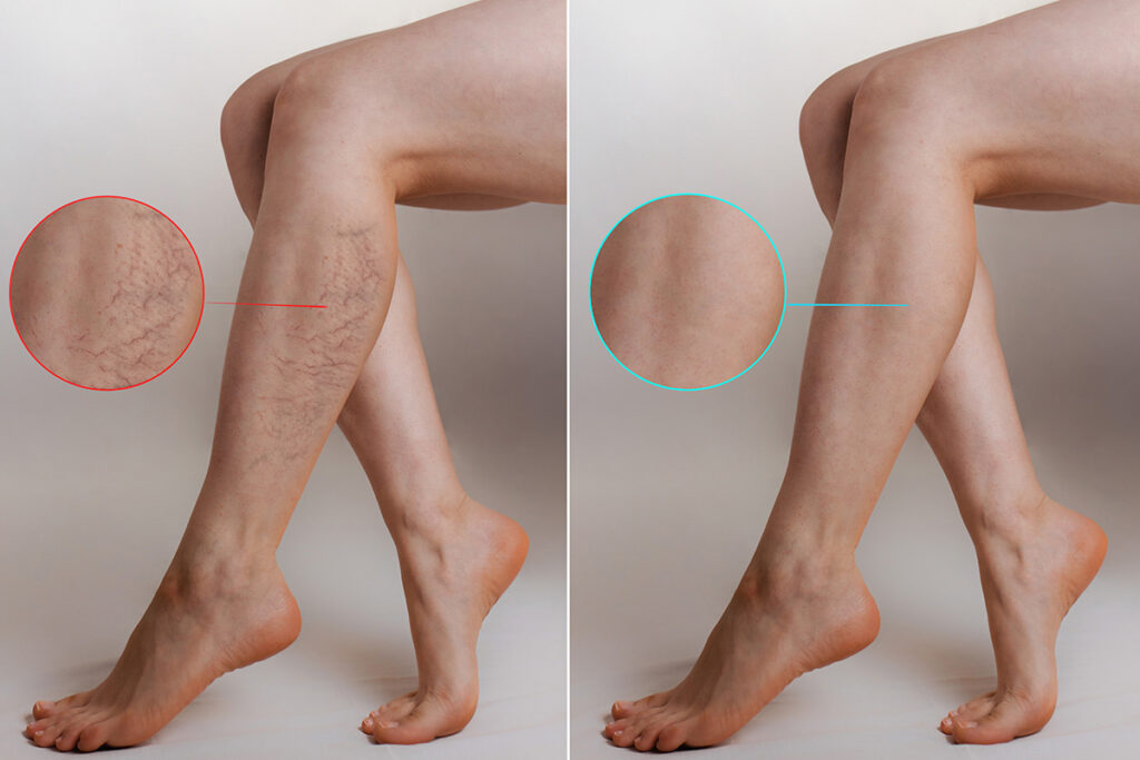 Varicose Veins: Symptoms, Causes, and Treatment Options 1 vein treatment aesthetic surgical images omaha ne 1
