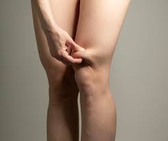 Knee Liposuction: Benefits, Procedure, and Recovery Tips 1 images 17