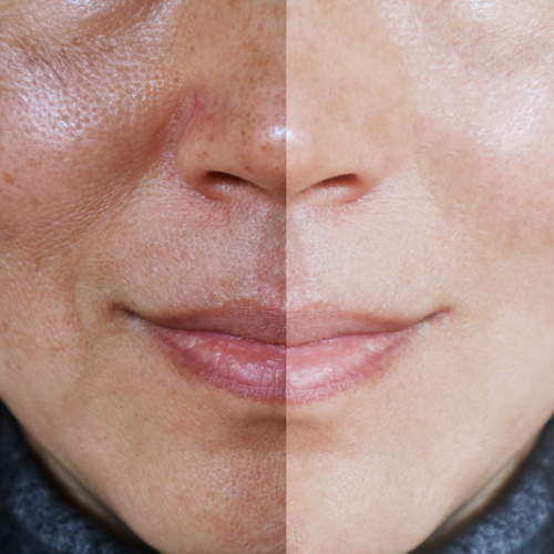 Fraxel Laser Treatment for Enlarged Pores: A Comprehensive Guide 1 open pores