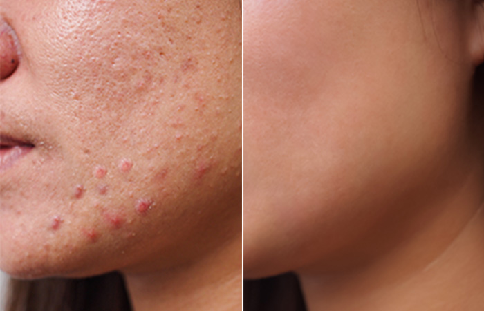 Before And After Using Blue Light