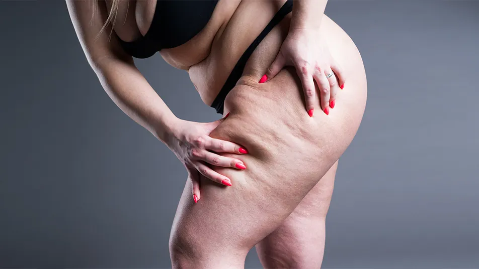 Lipedema and Liposuction Choosing the Best Approach