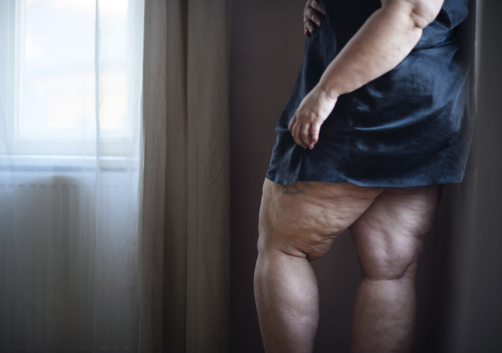 My Journey with Liposuction for Treating Lipedema 1 fat woman with cellulite on her legs cut out