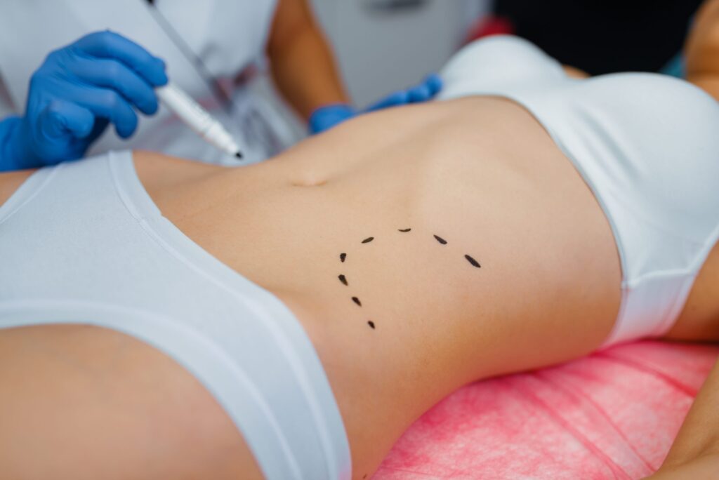 Comparing Awake Liposuction Costs: Is It Worth the Investment? 1 cosmetician applies markers to female patient body 9TJRFUZ scaled 1